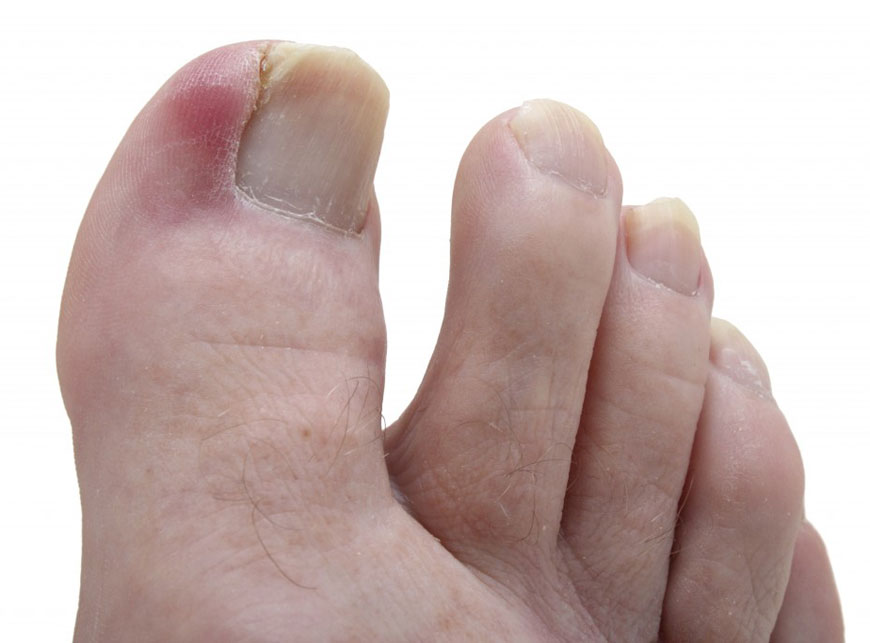 in-grown-toe-nails-nail-surgery