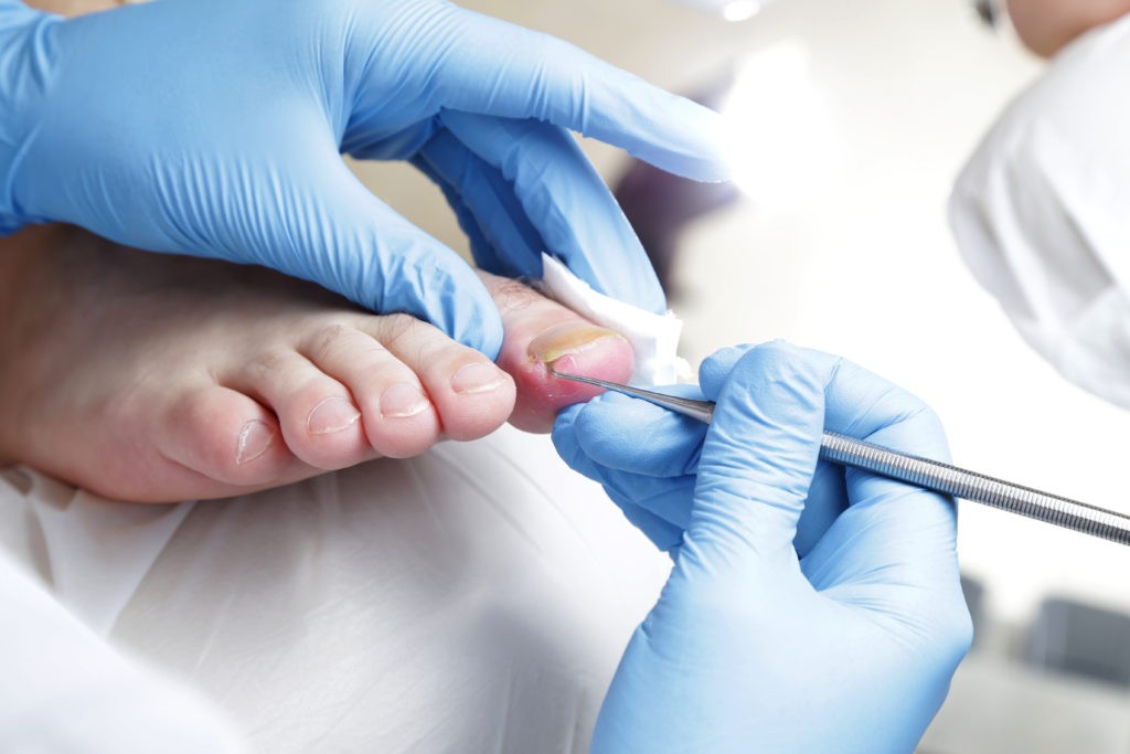 Is Ingrown Toenail Surgery Painful?