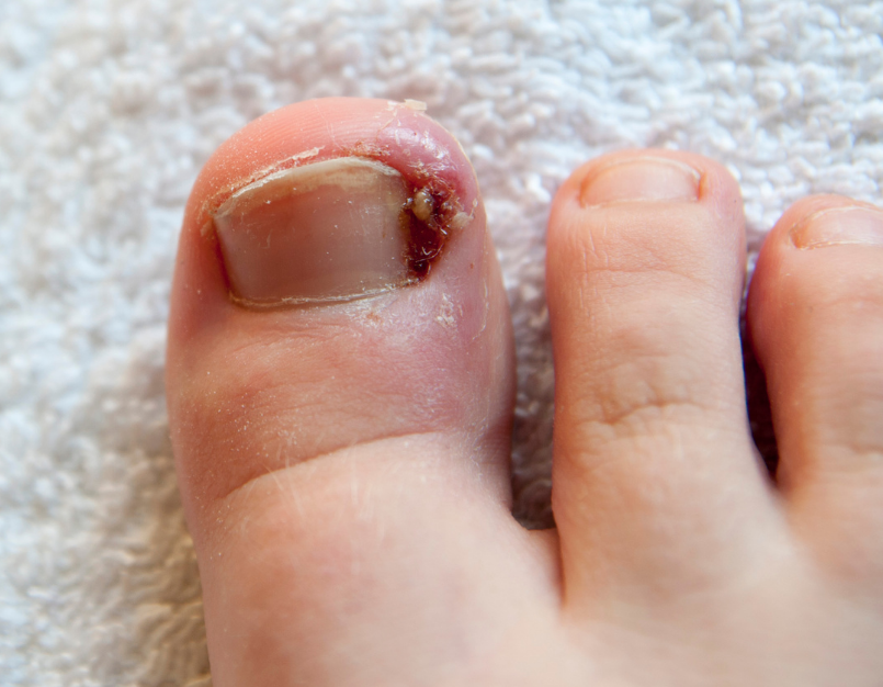 Ingrown Toenail Not Healing?