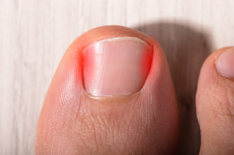 How To Spot An Ingrown Toenail Early