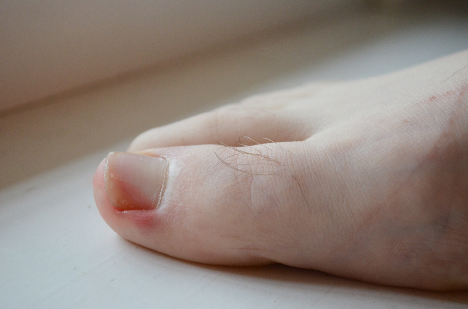 What Will Happen If An Ingrown Toenail Is Left Untreated?