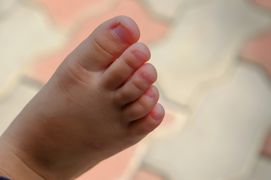 Help! My Child’s Ingrown Toenail Keep Coming Back