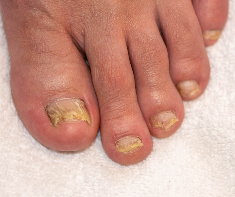 Why Do Toenails Thicken?