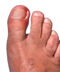 Is My Ingrown Toenail Causing My Toe To Feel Numb?