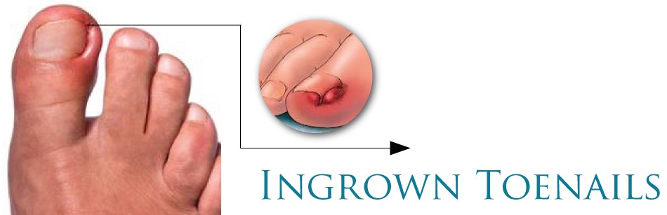 Struggling with ingrown toenails?