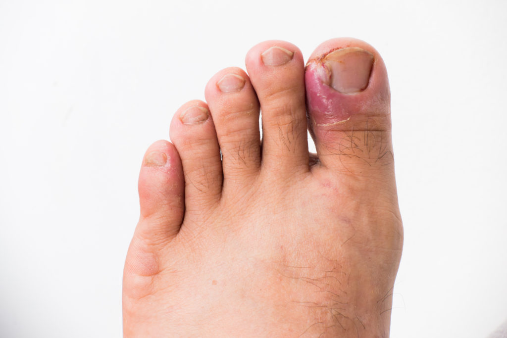 ingrown-toenails-why-it-s-time-to-throw-out-the-home-remedies