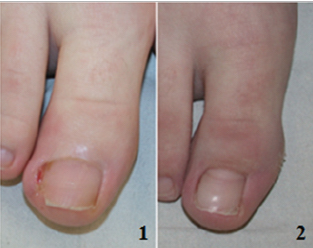 treatment for ingrown toenail