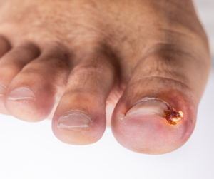 Your Ingrown Nail FAQs, Answered – Auckland Ingrown Toenail Clinic