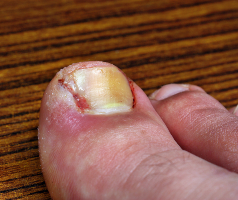 is-my-ingrown-toenail-infected-auckland-ingrown-toenail-clinic