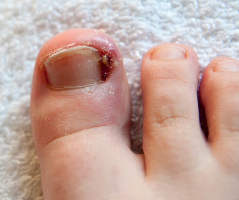 is-my-ingrown-toenail-infected-auckland-ingrown-toenail-clinic