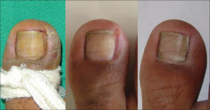 ingrown toenail removal before and after