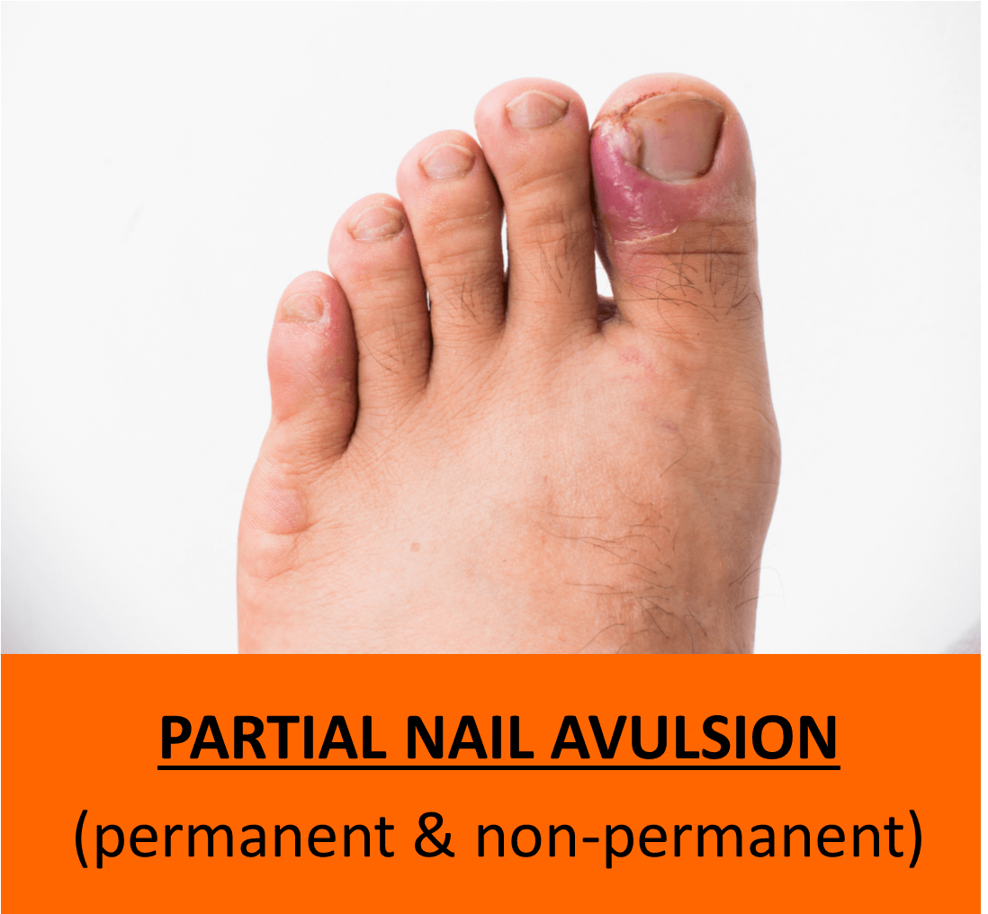 Total Nail Avulsion – Auckland Ingrown Toenail Clinic