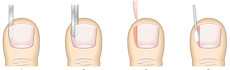 Treating onychocryptosis (ingrown toenail) with partial nail avulsion  surgery — Bondi Podiatry